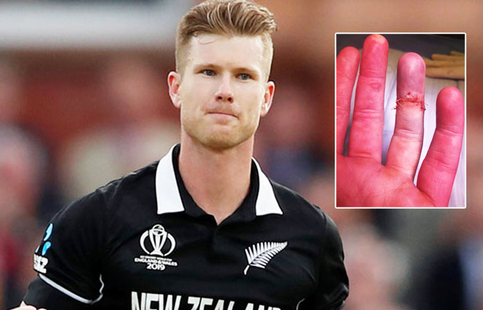 Jimmy Neesham the NZ All Rounder Made a Surgery on his Left Ring Finger